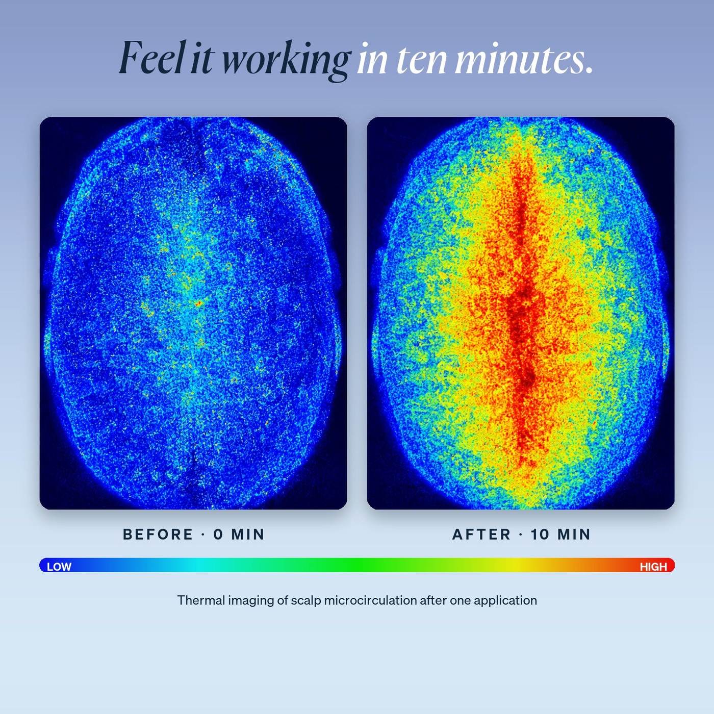 Thermal imaging: scalp microcirculation before and 10 minutes after one application